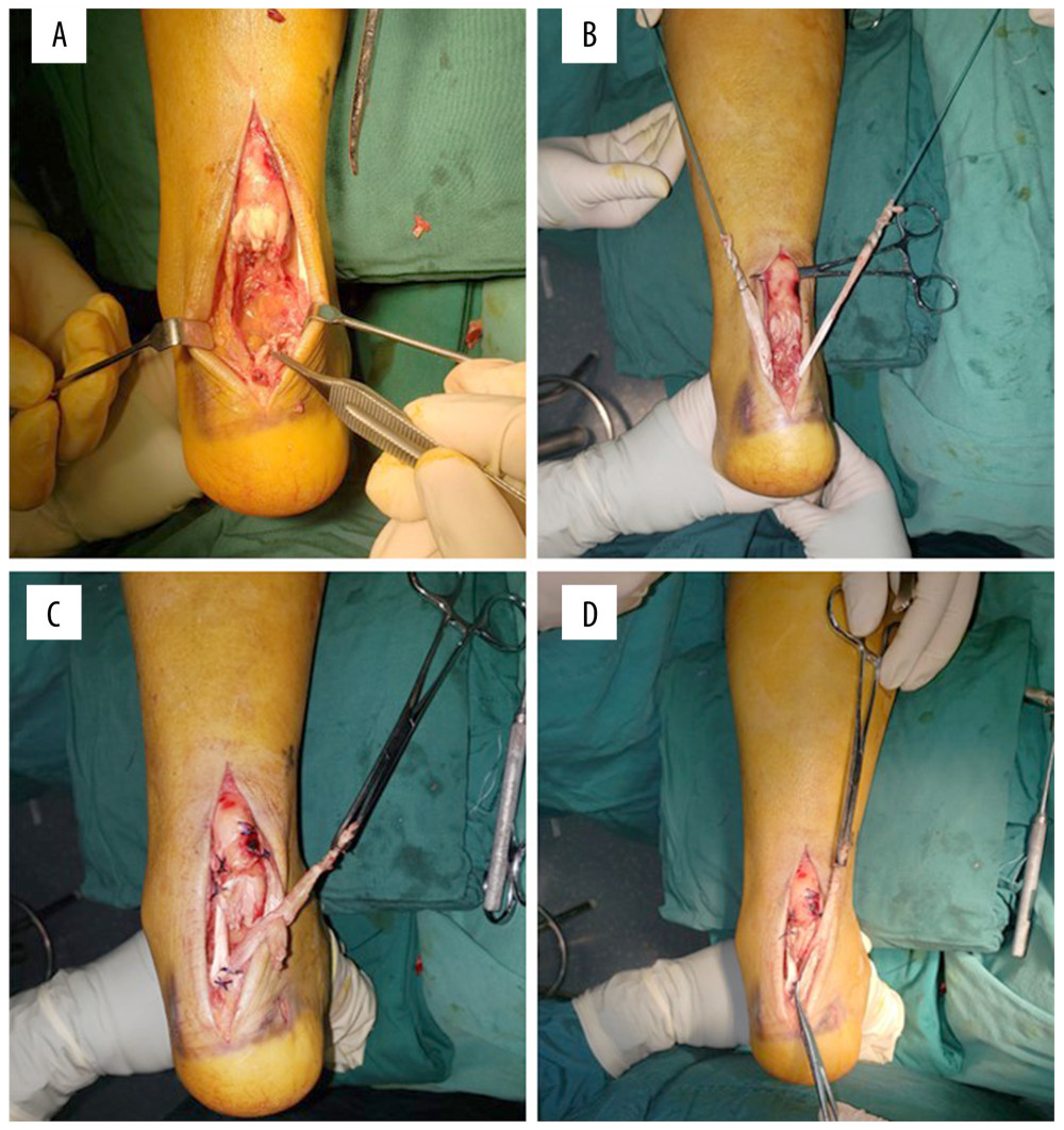 Suturing using allogenic tendon suture. (A) The Achilles tendon was completely separated, and the calcaneus protrusion was removed. (B) Allogeneic tendon was implanted. (C) Suturing was performed. (D) Suturing was complete.
