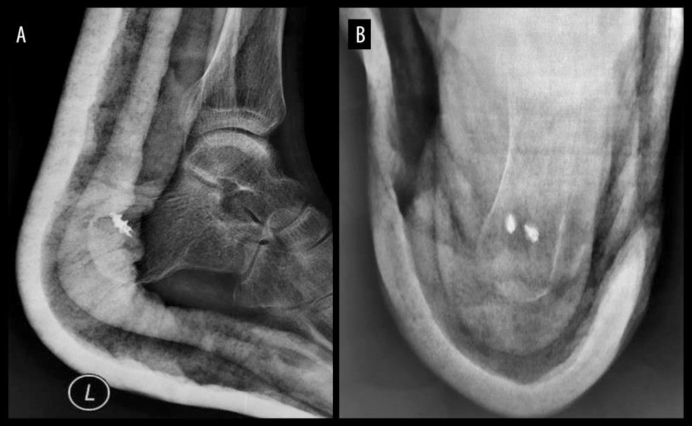 (A, B) Postoperative X-ray of anchor implantation in one patient.