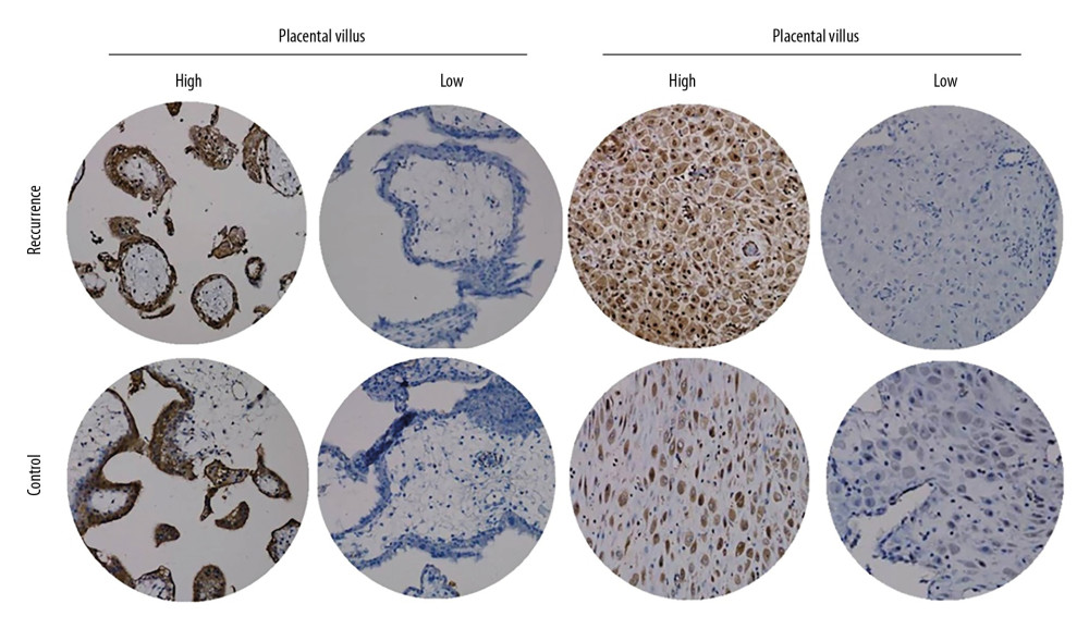 ATP6V1G3 protein expression in placental villus and decidual tissue of placenta of the Case and Control groups detected by immunohistochemistry assay. ATP6V1G3 protein was mainly expressed in the cytoplasm with brownish stain (200×).