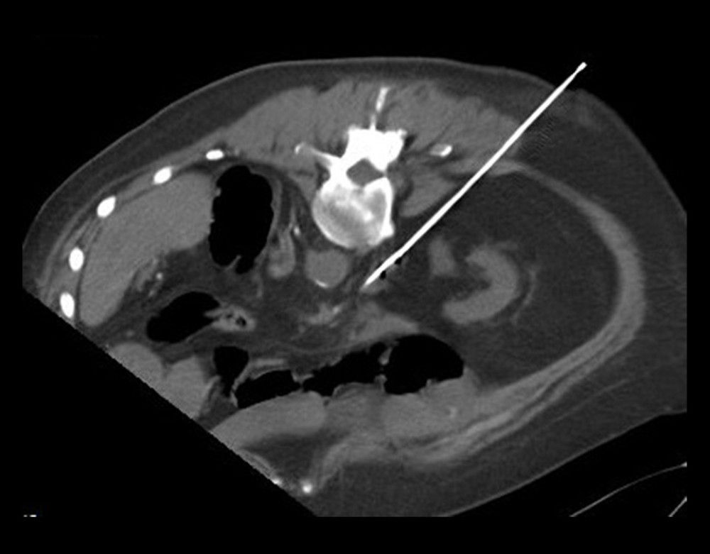 Computed tomography-navigated inferior vena cava puncture. Patient in prone position, oblique image along the needle plane.