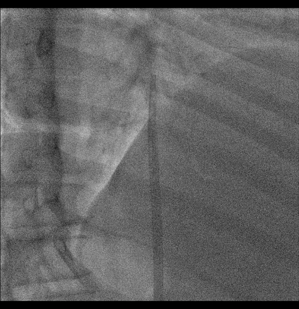 Fluoroscopy image upon completion of the procedure. Distal part of the catheter located in the right atrium of the heart.