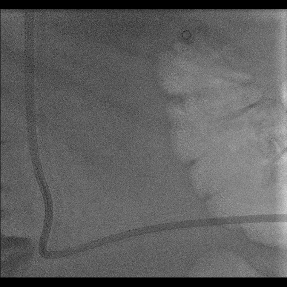 Fluoroscopy image upon completion of the procedure. Course of the catheter in the lumbar region.