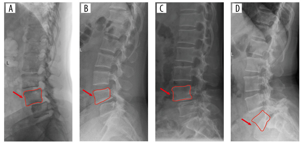 Degenerative spondylolisthesis: (A) Normal vertebral body, (B) Trapezoidal vertebral body; isthmic spondylolisthesis: (C) Normal vertebral body, (D) Trapezoidal vertebral body.