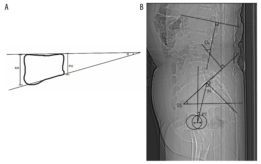 Visual representations of the methods applied to measure vertebral parameters and spine-pelvis sagittal parameters in radiographs are shown as follows: (A) AH: Anterior vertebral height. PH: Posterior vertebral height. Vertebral body angle (α): Angle between superior and inferior endplate of the vertebrae. (B) LL: The angle between lines parallel to the superior L1 endplate and the S1 endplate. SS: The angle between the superior S1 endplate and the horizontal plane. PT: The angle between the vertical plane and the line connecting the midpoint of the sacral endplate and the hip axis. PI: The angle between the line connecting the midpoint of the sacral endplate and the hip axis and a line perpendicular to the sacral endplate.