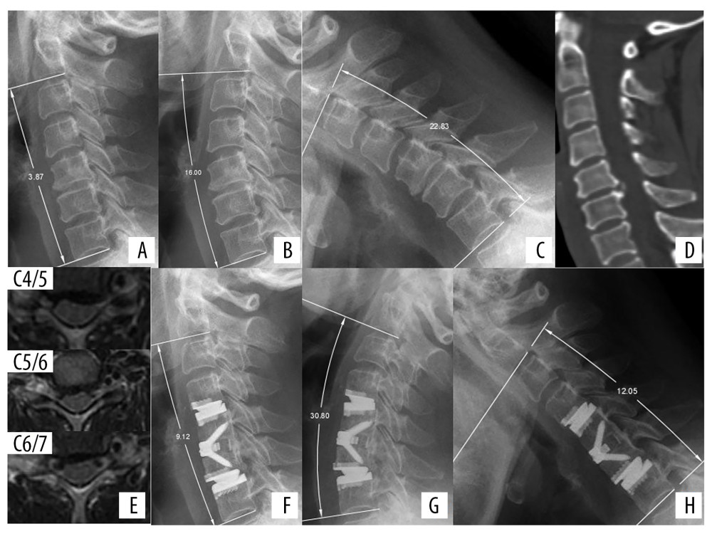 Radiologic examinations of a 55-year-old woman with neck pain for more than 2 years. (A) Preoperative lateral X-ray showing cervical lordosis at C2–C7 of 3.87°. (B, C) Flexion-extension view, showing that ROM at C2–C7 was 38.83°. (D) CT scan, showing osteophytes at the posterior border of C4–C5. (E) MRI showing herniated cervical discs at C4/5, C5/6, and C6/7, causing pressure on the spinal cord. CDR was performed at C4/5 and C6/7 and ACDF at C5/6. (F) X-ray immediately after surgery, showing a cervical lordosis of 9.12°. (G, H) Flexion-extension view at 1 year, showing that ROM at C2–C7 was 42.85° (110.35% compared with preoperative ROM).
