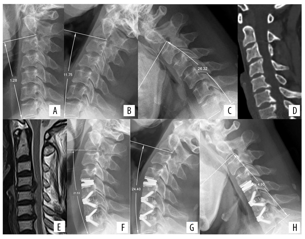 Radiologic examinations of a 52-year-old woman with neck pain for 2 months and numbness in both hands for 1 week. (A) Preoperative lateral X-ray showing cervical lordosis at C2–C7 of 1.28°. (B, C) Extension-flexion view showing that ROM at C2–C7 was 38.07°. (D) CT scan showing osteophytes at the posterior borders of C5/6 and C6/7. (E) MRI showing protrusion of intervertebral discs at C4/5, C5/6, and C6/7. CDR was performed at C4/5 and ACDF at C5/6 and C6/7. (F) Lateral X-ray view immediately after surgery, showing cervical lordosis of 21.53°, a significant improvement compared with preoperative lordosis. (G, H) Extension-flexion X-ray at 1 year, showing that ROM of C2–C7 was 29.30°.