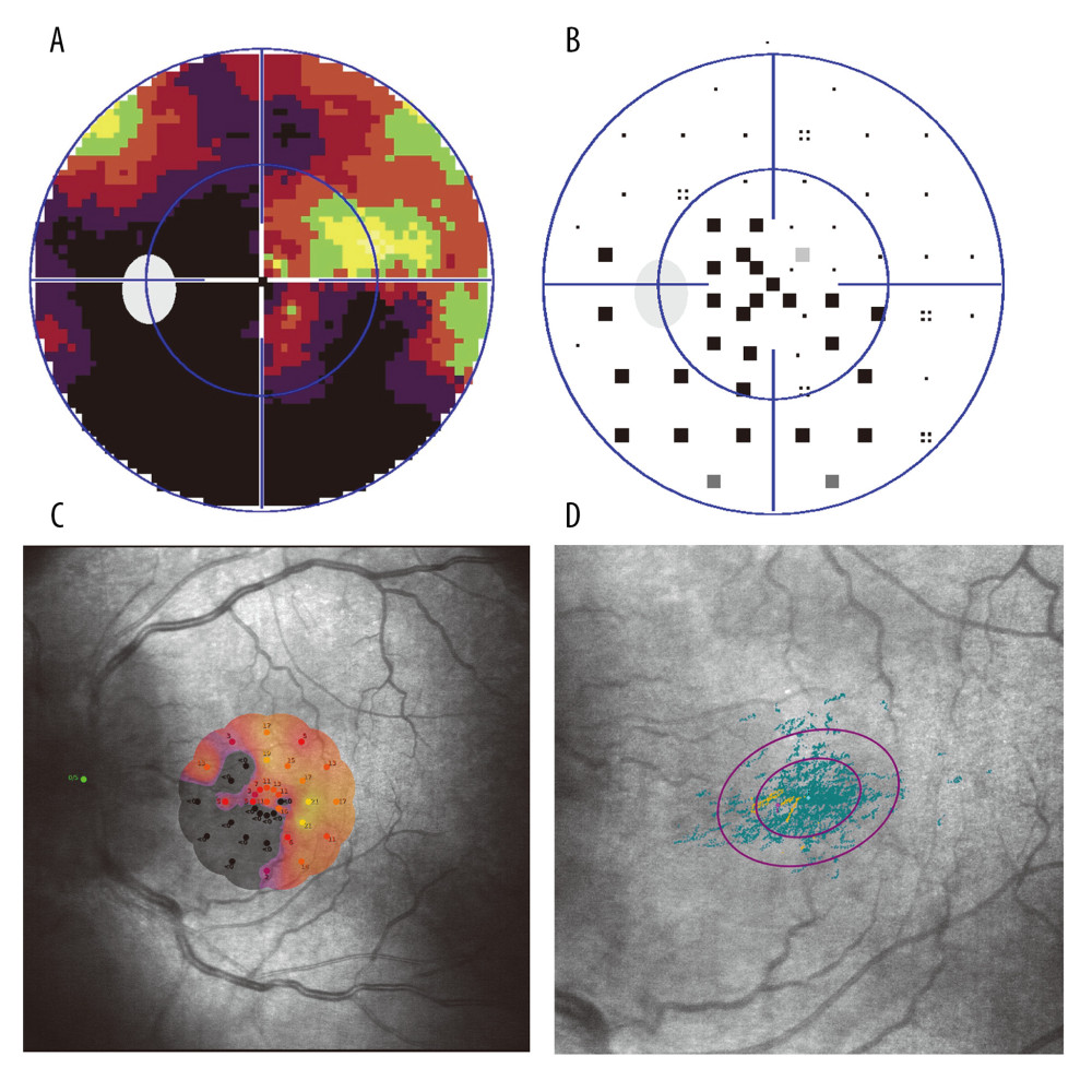 (A) Gray-scale image of 30° central visual field observed by Humphrey perimetry from a NAION patient, showing a superior fan-shaped defect connected to the optic disc. (B) Correction map of the visual field of the same patient, showing a superior fan-shaped defect connected to the optic disc. (C) Macular micro-visual field changes corresponding to the visual field defect shown in (A). The microMS value was 7.1 dB. P1 and P2 were 94% and 100%, respectively. Fixation was relatively stable. (D) Fixed view of microperimetry. P1=41% and P2=80%.