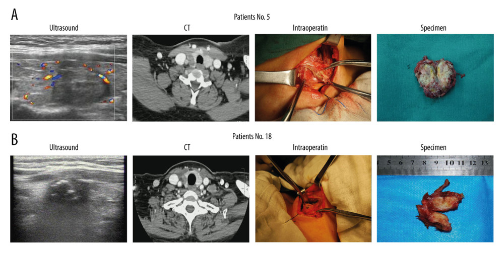 Preoperative ultrasound, contrast-enhanced computed tomography (CT) evaluation and intraoperative findings. (A, B) Ultrasound, CT, intraoperative, and nodule specimens of 2 patients (numbers 5 and 18) in whom the thyroid lesion simultaneously adhered to or invaded the strap muscles and recurrent laryngeal nerve.