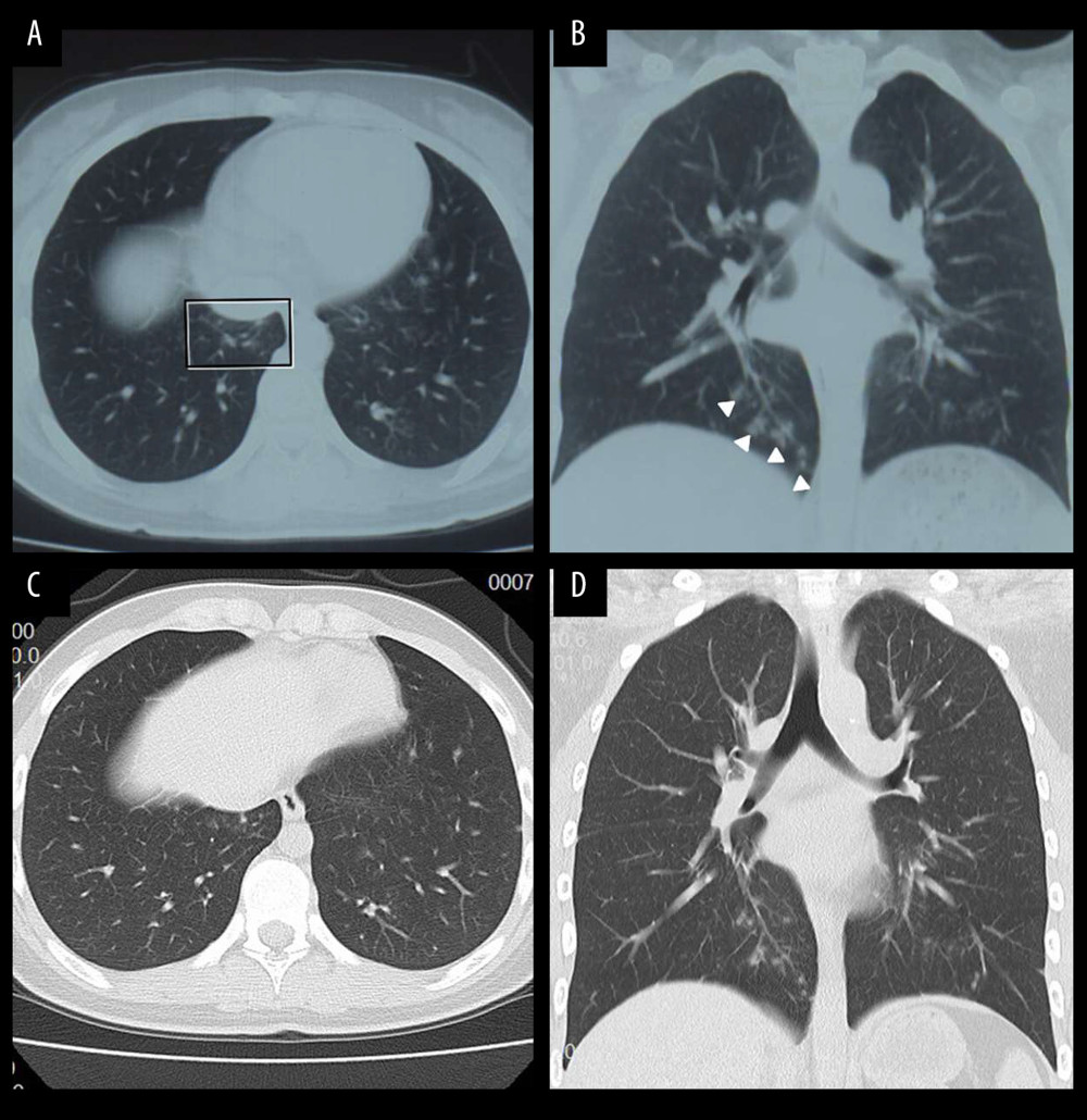 Computed tomography images of a 13-year-old girl (case F from family 1) 2 days after exposure to patients positive for COVID-19 (grandfather and father). (A) Ground-glass opacities and (B) nodules (arrow) were seen in the medial-basal segment of the right lung. Five days later, the ground-glass opacities were (C) absorbed and the nodules were (D) smaller.