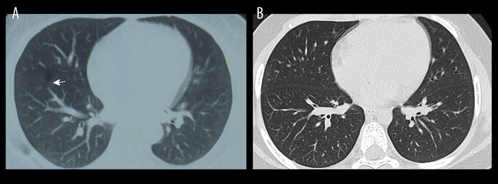 Computed tomography images of a 7-year-old boy (case A from family 1). (A) Ground-glass opacities (arrow) were seen in the anterior basal segment of the right lung. (B) Seven days later, the ground-glass opacities of the right lung were absorbed completely.