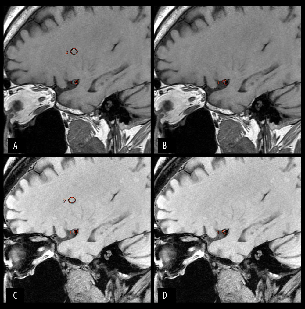 Typical images of a patient with MCA stenosis. (A, B) 3D CUBE T1 sequence without fat suppression. (C, D) 3D CUBE T1 sequence with fat suppression. Two ROIs for signal intensity measurements are separately depicted as circles in the lumen (circle 1) and brain white matter (circle 2) on images A and C. An ROI for signal intensity measurement is depicted as a circle (circle 1) in the plaque on images B and D.
