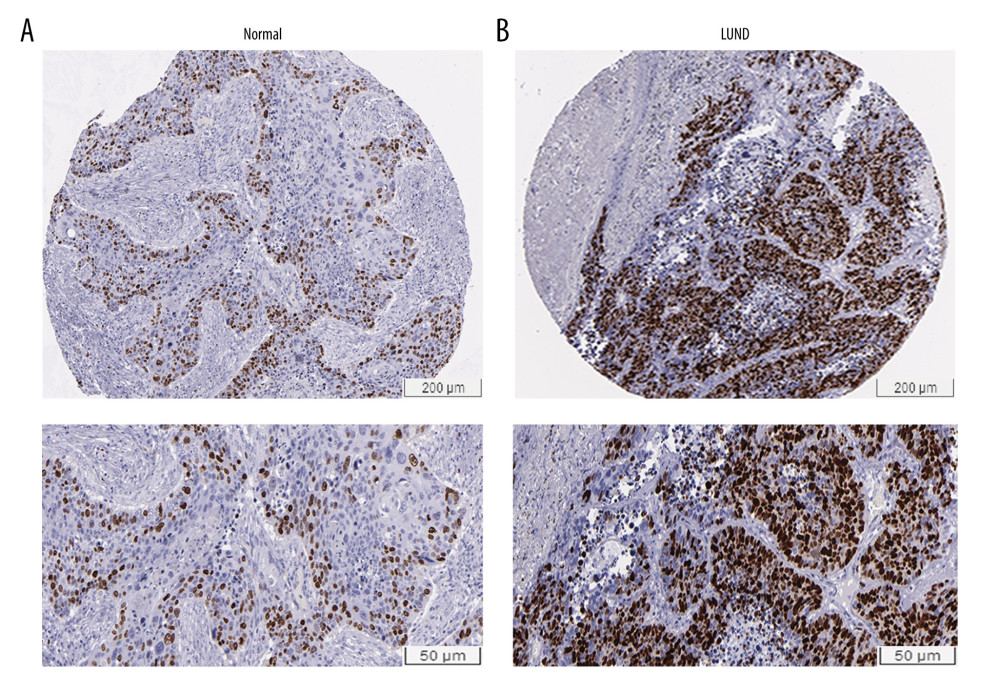 Immunohistochemical examination for expression of TOP2A in normal lung and LUAD tissue. (A) TOP2A expression in normal lung tissues. (B) TOP2A expressions in LUAD tissues.