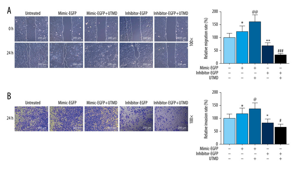 Effects of UTMD-mediated miR-21 transfection on HeLa cell migration and invasion. (A) Wound healing experiments were performed to detect the effects of miR-21 plasmid on HeLa cell migration in the untreated, mimic-EGFP, mimic-EGFP+UTMD, inhibitor-EGFP, and inhibitor-EGFP+UTMD groups (ultrasonic intensity was 1.5 W/cm2). (B) The transwell migration assay was used to detect the effect of the miR-21 plasmid on HeLa cell invasion (ultrasonic intensity was 1.5 W/cm2). UTMD: Ultrasound-targeted microbubble destruction; EGFP: enhanced green fluorescent protein. * P<0.05 and ** P<0.01 vs untreated; @ P<0.05 and @@ P<0.01 vs mimic+EGFP; # P<0.05 and ### P<0.001 vs inhibitor+EGFP. UTMD – ultrasound-targeted microbubble destruction; EGFP – enhanced green fluorescent protein.