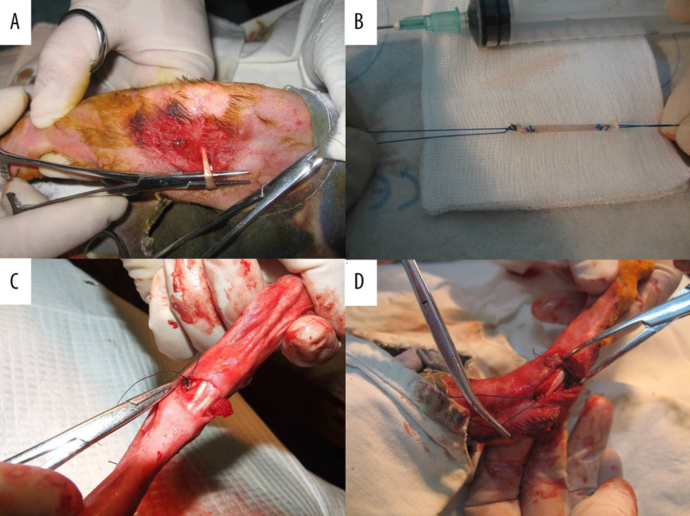 (A) The semitendinosus was located and cut approximately 3 cm from the border of the tendon muscle for attachment to the tibia. (B) The semitendinosus strand was woven with a 3-0 polyester thread at both ends. (C) The talar terminal was fixed with a 1.5 cm-diameter steel-wire button. (D) One strand of a thread from the calcaneal terminal was passed through the tunnel and fastened with another thread to form a bone-bridge fixation while the graft kept tension.