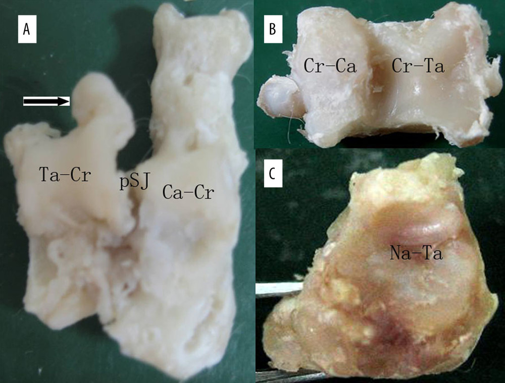 Specimen sacrificed at 32 weeks after resection surgery in group II: (A) A specimen of the talus and calcaneus. The black arrow shows the enormous osteophyte at the posterior subtalar joint. (B) A specimen of the crus. The degeneration of the calcaneal surface of the crus (Cr-Ca) was more severe than the talar surface of the crus (Cr-Ta). (C) A specimen of the talar surface of the navicular (Na-Ta). Ca-Cr – crural surface of the calcaneus; Cr-Ca – calcaneal surface of crus; Cr-Ta – talar surface of the crus; Na-Ta – talar surface of the navicular; pSJ – posterior subtalar joint; Ta-Cr – crural surface of the talus.