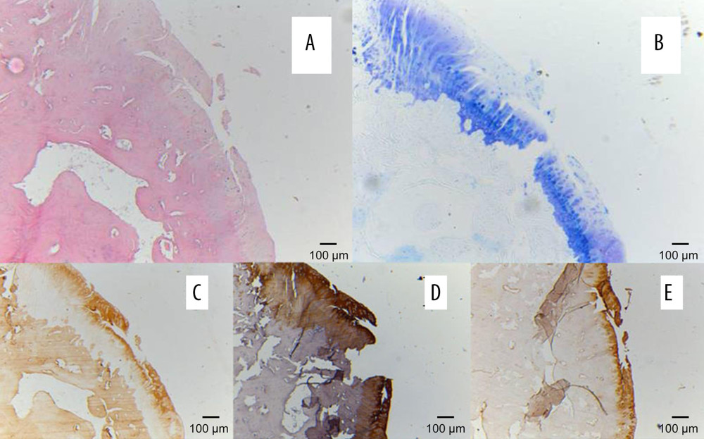 Pathology results of the talar surface of the calcaneus (Ca-Ta) of the posterior subtalar joint in group II: (A) Fibrosis and a cluster of chondrocytes seen in the cartilage of the medial condyle (HE×5). (B) Loss of toluidine blue is seen in majority of the cartilage. (C) Type I collagen strongly and diffusely positive at 32 weeks in group I (immunohistochemistry ×5). (D) Type II collagen was uneven in the deep layers (immunohistochemistry ×5). (E) Type III collagen was strongly and diffusely positive (immunohistochemistry ×5).