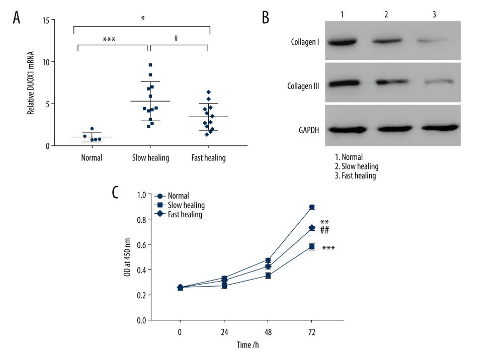 DUOX1 was highly expressed in slow-healing granulation tissue of burn wounds (A) Clinical burned wounds with fast healing (n=12) and slow healing (n=12) granulation tissue and normal tissue (n=6) were collected, and Q-PCR was used to detect the expression of DUOX1. Primary fibroblasts were isolated from fast-healing, slow-healing, and normal tissues. (B) Collagen I and III protein levels were detected by Western blotting. (C) Cell proliferation was detected by CCK8 at 0, 24, 48, and 72 h. * P<0.05, ** P<0.01, *** P<0.001 vs normal; # P<0.05, ## P<0.01 vs slow-healing. Normal tissues: skin tissue taken from the surface of traumatic injury, fast-healing granulation tissue: better recovery after 14 days’ treatment, slow-healing (n=12) granulation tissue: poor recovery after 14 days’ treatment.