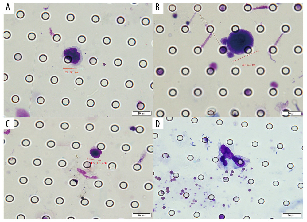 Circulating tumor cells (CTC)/circulating tumor microemboli (CTM) detected with the CTC-Biopsy system in patients with gastric cancer. Wright-Giemsa staining was performed for cytomorphological analysis. (A) CTC: nuclear-cytoplasmic ratio >0.8, irregular nuclear shape. (B) CTC: cell diameter >15 μm; abnormally large nucleoli. (C) CTC: thickened and wrinkled, with jagged nuclear membranes and side-shifted chromatin. (D) CTM: aggregation of tumor cells (≥3). All cells were analyzed under 40× magnification. Scale bar: 20 μm.