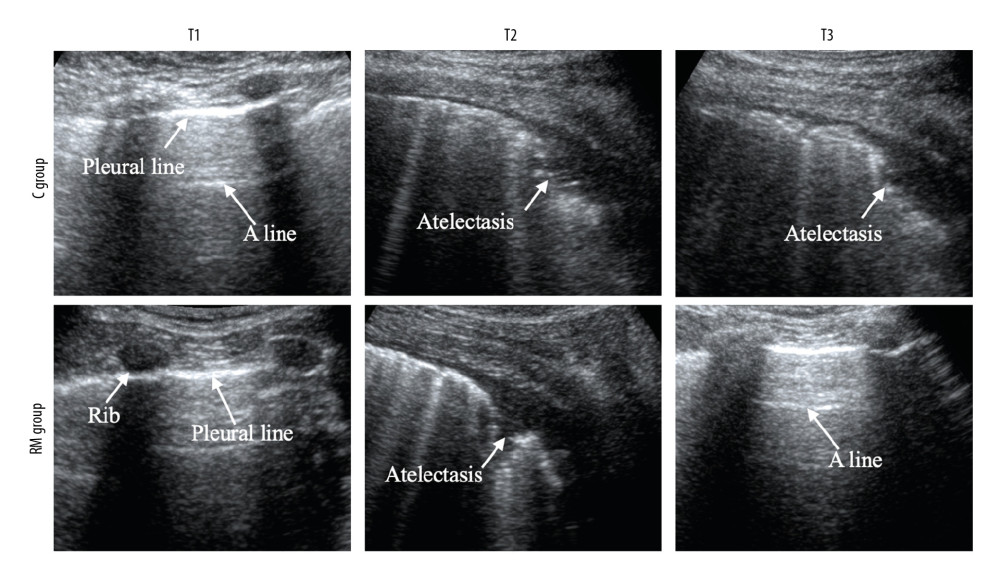 Lung ultrasound images of 1 representative patient per group. C group – control group; RM group – lung recruitment maneuver group. T1 – before the induction of anesthesia; T2 – at the end of the surgical procedure; T3 – 30 min after extubation.