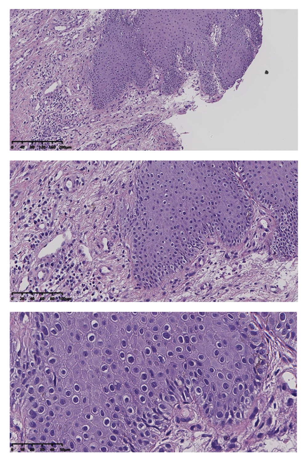 Squamous epithelial atrophy, acellular collagen degeneration zone in the superficial dermis, and inflammatory cell infiltration, consistent with vulvar sclerosing lichen.