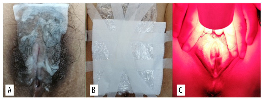 (A) 5-aminolevulinic acid (ALA) to the leukoplakia of the vulva. (B) Cling film to cover the ALA. (C) Illumination for 20 min exposure time at 60–90 mW/cm2 power.