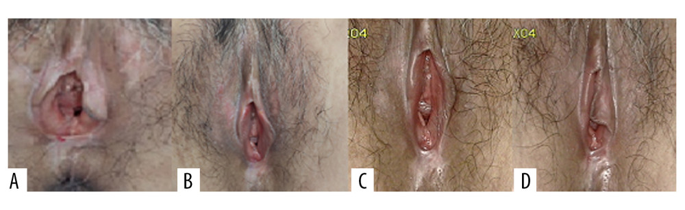 Representative images of vulvar lesions of 1 patient receiving 5-aminolevulinic acid-photodynamic (ALA-PDT) for 3 times during 6 months of follow-up. (A) Pre-treatment; (B) 1-month follow-up; (C) 3-month follow-up; (D) 6-month follow-up. A significant clinical improvement was achieved, showing reduced hyperkeratosis and decreased area of vulval lesions, and even the hypopigmentation was completely improved.