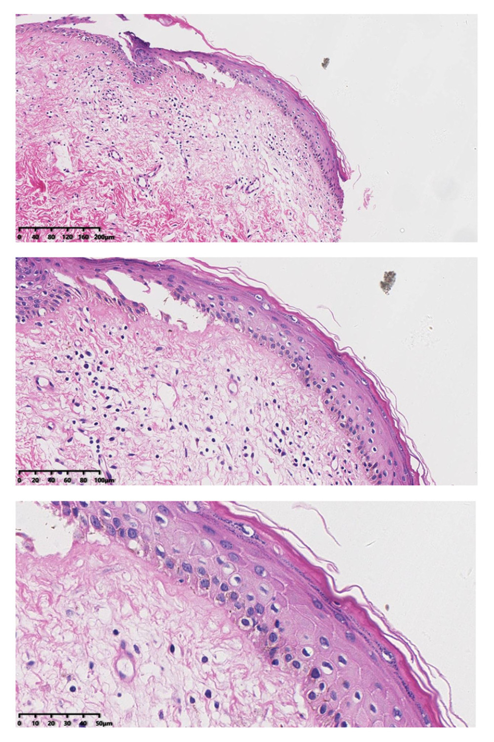 After treatment, histopathology results showed that chronic inflammation and acellular collagen band in dermis disappeared and superficial epithelial vacuolar degeneration improved.