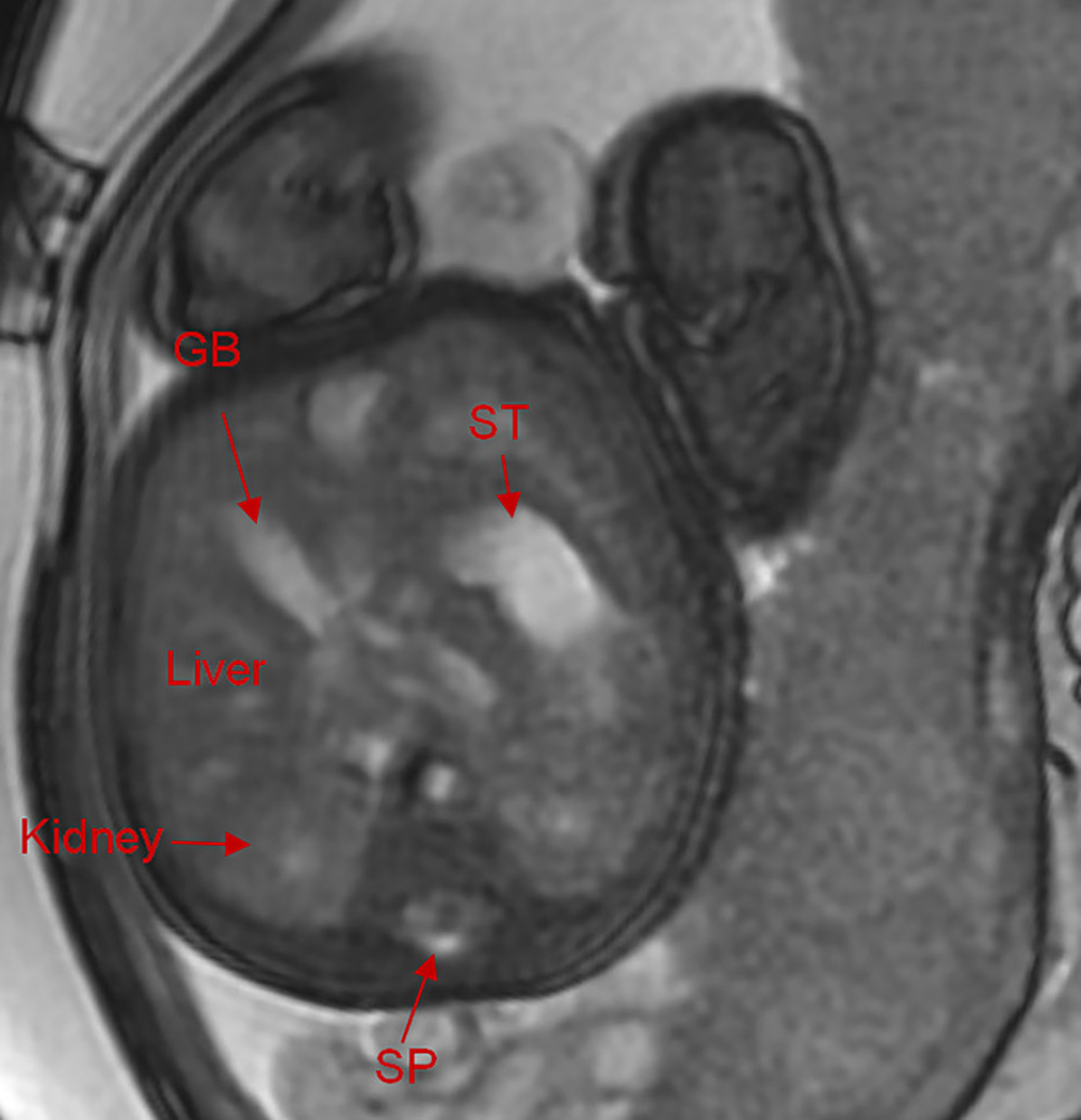 The MRI in 1 patient with PNVGB at 33 gestational weeks showed a normal gallbladder (3.2×1.2×1.2 cm). GB – gallbladder; ST – stomach; SP – spleen.