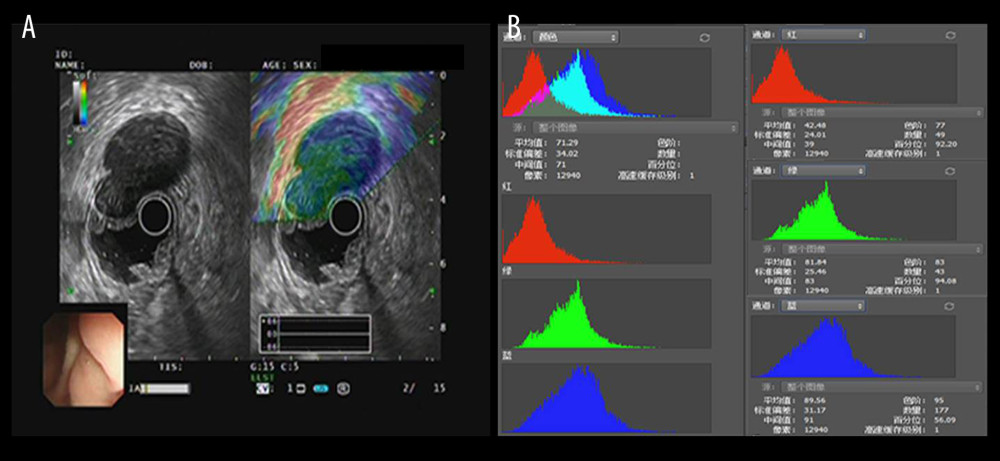 The introduction of EUS elastography image (A) and hue mean histogram (B). The image shows the EUS and EUS elastography of a patient with gastrointestinal stromal tumor in stomach. Figure A the left part is an EUS image, on which we can see 5 layers of the gastric tract wall, lined mucosa, muscularis mucosa, submucosa, muscularis propria, and serosa from inside to outside, and the focus sited in the layer of muscularis propria. Figure A the right part is an EUS elastography image, which is superimposed by colors of blue (hard tissues), green (intermedium tissues), and red (soft tissues) according to different elasticity produced by different tissues. The bottom-left corner is the appearance of electronic endoscopy. Figure B this picture shows the mean hue histogram of an area we selected (ROI). There were 4 channels: the front-most is the RGB channel, which was mixed by following 3 channels of R channel, G channel, and B channel. Each image shows the mean value and SEM; for example, 71.29 and 34.02 of RGB channel in this picture. Simultaneously, we obtained mean values of separated channels of R, G, and B respectively.