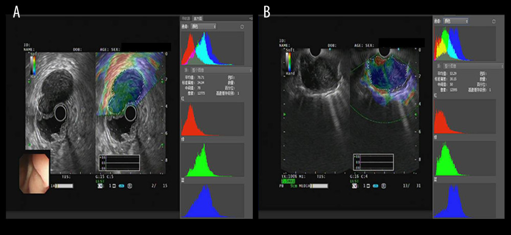 The EUS elastography images of GIST (A) and GIL (B). The pictures were print-screened from Photoshop CC in the process of hue histogram analysis. We obtained Figure A from a patient with GIST and Figure B from a patient with GIL by use of the elastography system in our hospital. In these pictures, the left side shows EUS and EUS elastography images and the right side shows the hue histogram of the region of interest (ROI), circled by a dotted line in the left side as the picture. There are 4 channels – RGB, R, G, and B – in the hue histogram and mean hue histogram values, and their standard deviations were calculated as 70.71±30.34 (A) and 53.29±30.15 (B) in the RGB channel.
