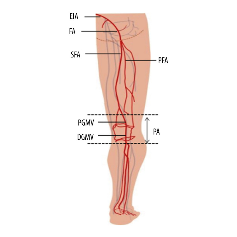 Schematic illustration of vascular injury sites in lower extremity. EIA – extemal iliac artery; FA – femoral artery; PFA – profounda femoral artery; SFA – superficial femoral artery; PA – popliteal artery; PGMV – proximaI gastrocnemius muscle vascular; DGMV – distal gastrocnemius muscle vascular.