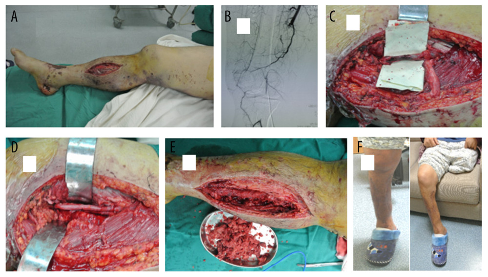 A typical example of delayed repair of SFAI (72 h). A 41-year-old man was struck by a car. In a local hospital, a closed dislocation of his right knee joint was reduced 8 h after the injury and an amputation was performed in his left leg due to the severity of the injury. Three days later, the patient was transferred to our hospital to treat the limb ischemia. A few mottling and some muscle-necrosis wounds were found on his foot (A). The angiography demonstrated injury to the superficial femoral artery, but the lateral branches of the deep femoral artery and the anterior and posterior tibial arteries were clearly presented (B). Intraoperatively, SFAI with long-segment embolus (C) was revascularized by SVG (D). After multiple debridements to remove necrotic tissue (E), the incision of the decompression of compartment was sutured. Lower extremity follow-up at 32 months showed good ankle and knee functions (F).