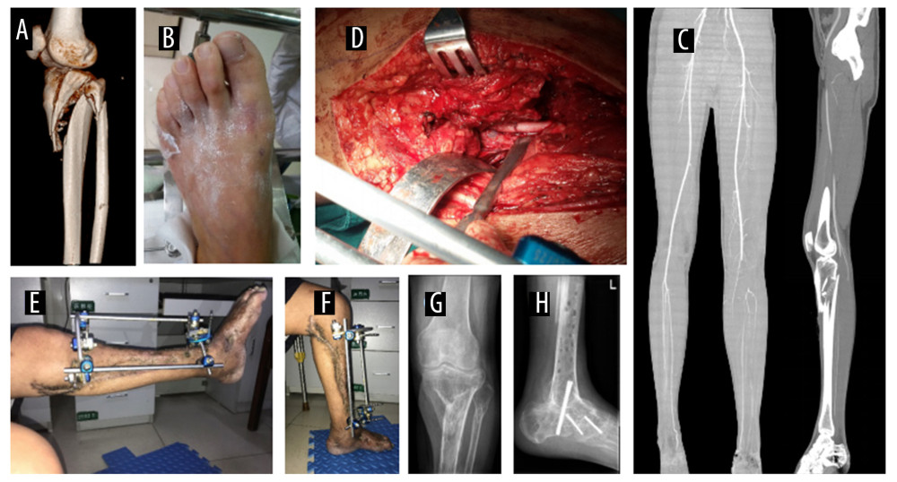 A typical example of delayed repair of PAI at DGMV (60 h). A 41-year-old man was admitted to a local hospital due to a traffic accident, suffering tibia and fibula fractures with a popliteal artery injury of his left leg (A). At 2 days after trauma, the patient was transferred to our hospital. The skin color of the left foot seemed normal but there was no pulse (B). CTA revealed popliteal artery embolization at DGMV, but the blood signal of the gastrector artery, the calf artery, and the collateral circulation were very clear (C). The PAI was confirmed intra-operatively, and revascularization was performed by end-to-end anastomosis (D). After external fixation of the fracture, good knee function was presented (E, F). However, 1 year after fracture healing, poor ankle function (clubfoot deformity) was corrected by four-joint fusion (G, H).