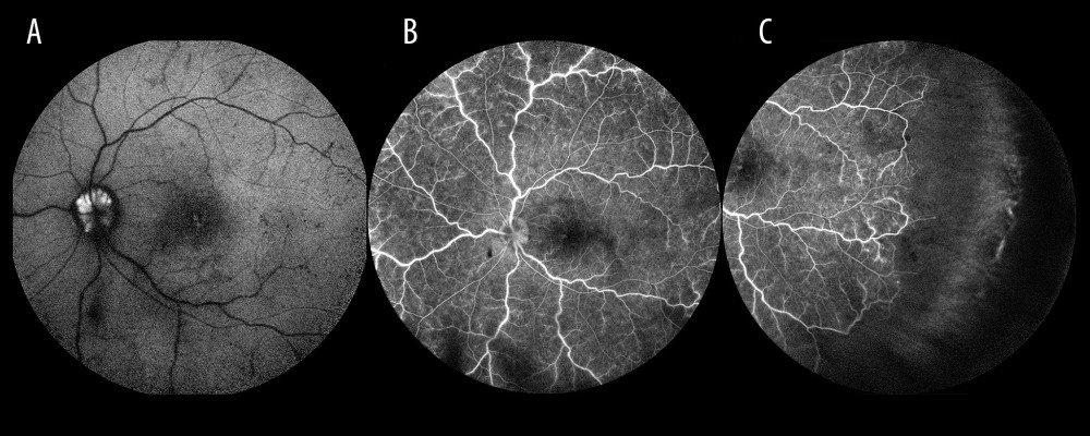 Optic disc drusen. (A) Autofluorescence from drusen on the optic disc. (B) Occlusion of the vein trunk without features of ischemia in the posterior pole (the same eye). (C) Extensive avascular zones in the peripheral temporal retina (the same eye).