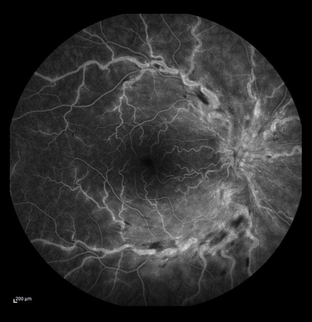 Non-ischemic occlusion. Dye leakage from the damaged veins and on the optic disc, but no avascular zones visualized in the posterior pole.