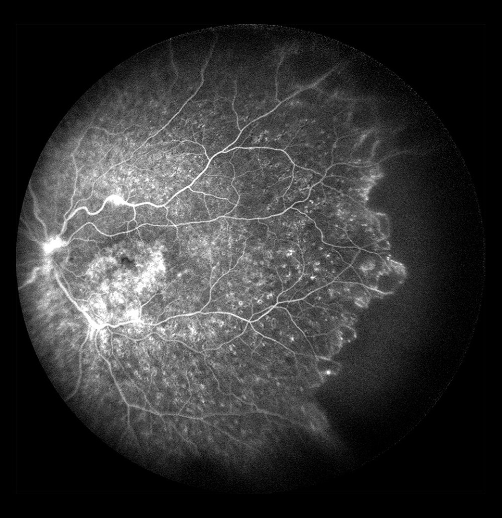 Non-ischemic occlusion in the posterior pole with extensive avascular zones and amputated vessels in the peripheral temporal retina. Dye leakage on the optic disc and cystoid macular edema (after laser photocoagulation).