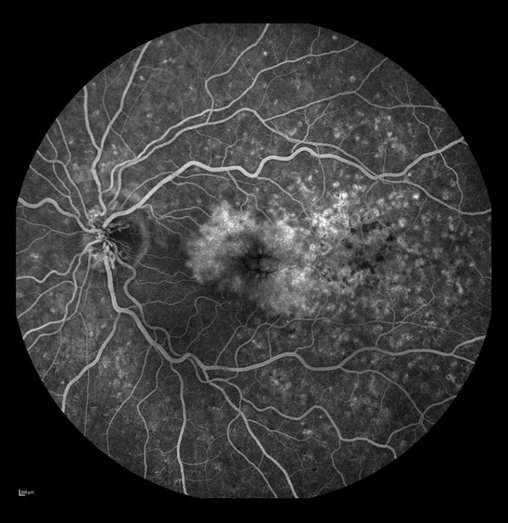 Occlusion of the vein trunk with new vessels on the disc and cystoid macular edema (after laser photocoagulation).