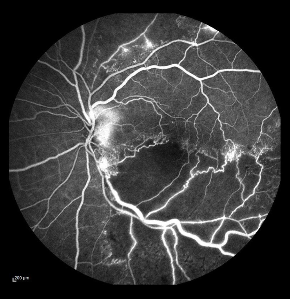 Ischemic occlusion of the inferior temporal bone with the development of collateral circulation. Veno-venous anastomoses are visible on the nasal and temporal sides of the macula.