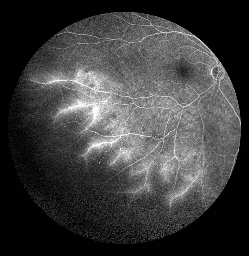 Occlusion of the inferior temporal branch with dye leakage in the peripheral retina.