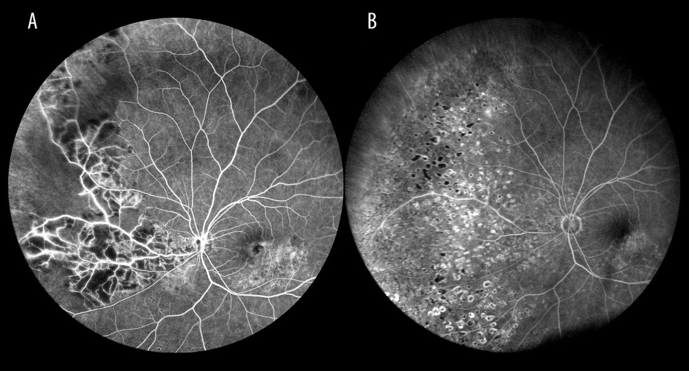 Ischemic occlusion of the inferior nasal branch. (A) Before laser photocoagulation. (B) After laser photocoagulation, the impact of photocoagulation is seen in the far retinal periphery.