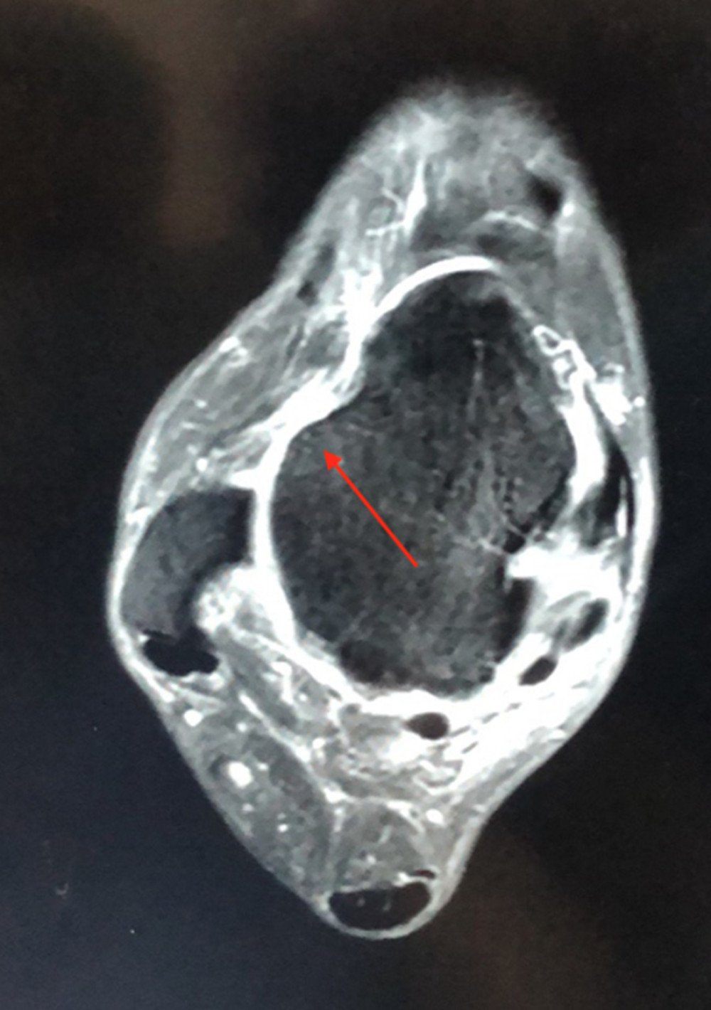 A 2-dimensional MRI image of a 45-year-old patient with anterior talofibular ligament (ATFL) injury, revealing a complete ATFL tear (arrow).