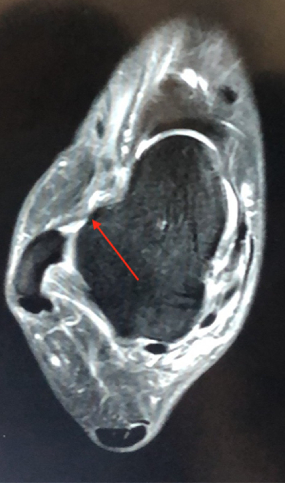 A 3-dimensional (3D) MRI image of a 45-year-old patient with an anterior talofibular ligament (ATFL) partial tear (arrow); this image was on the same section of 2D MRI. A break in 1 of the ATFL bundles was observed, but the ATFL was still consistent.
