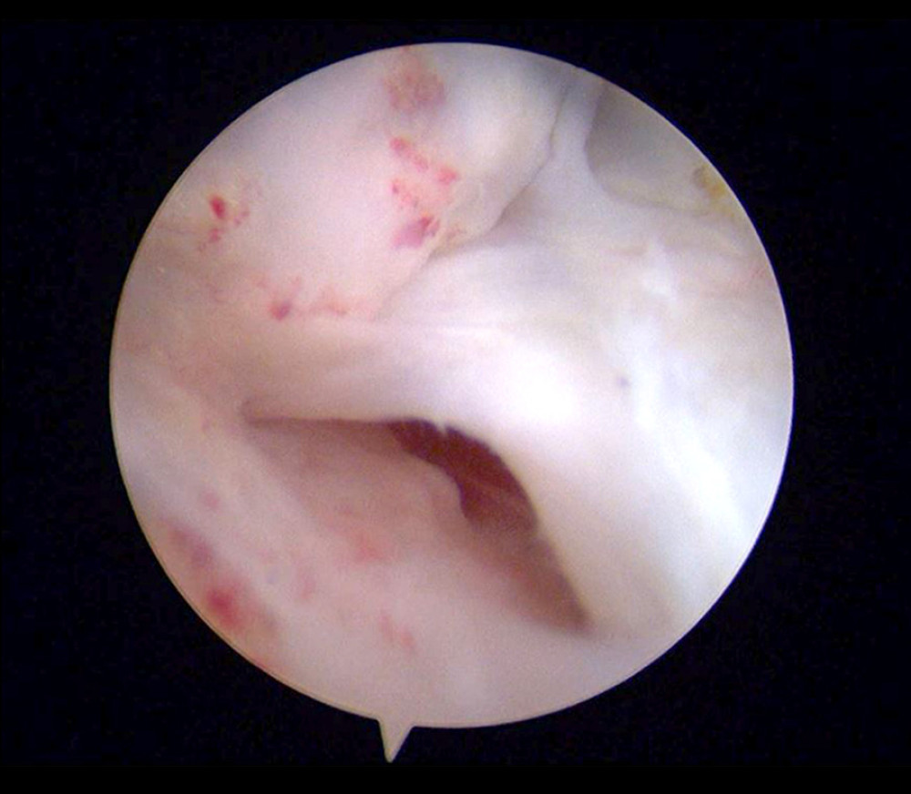 An arthroscopic image of a 45-year-old patient with an anterior talofibular ligament (ATFL) partial tear. The an ATFL had weakened tension and was partially broken. The results were consistent with those of MRI.