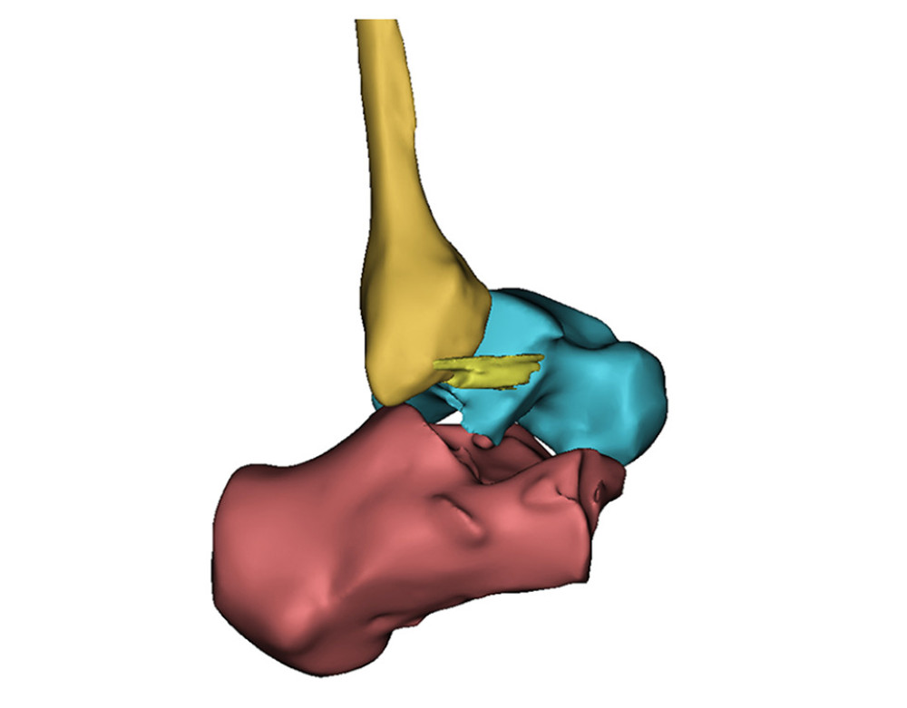 A 3-dimensional reconstruction model showing an anterior talofibular ligament partial tear. The results were consistent with arthroscopic surgery findings.