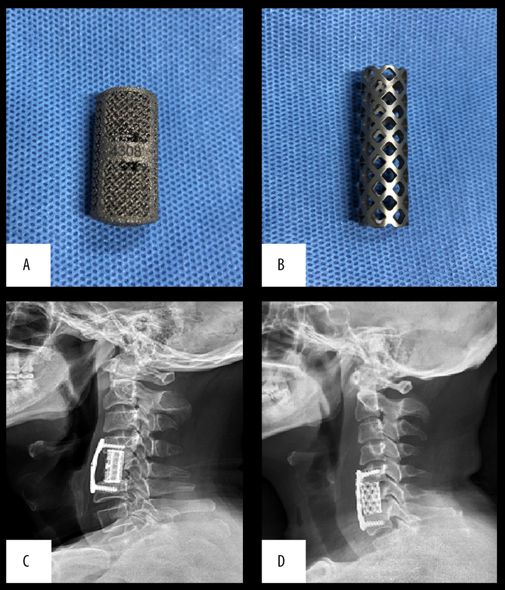 (A, C) Show examples of 3D-printed artificial vertebral bodies. (B, D) Show the examples of TMCs.