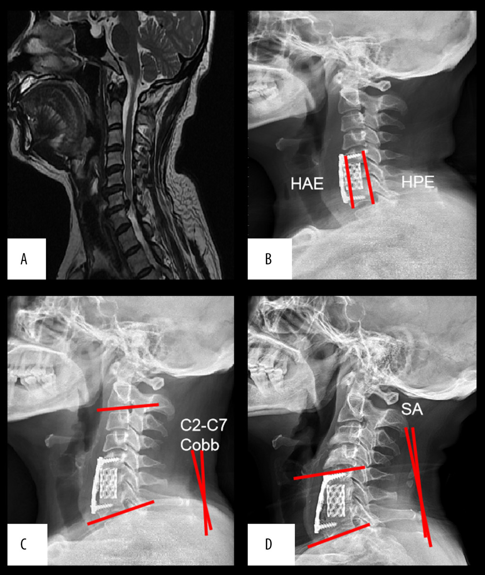 (A) Preoperative MRI showed obvious C6/7 intervertebral disc herniation, spinal stenosis, and nerve compression (B) 1 week after surgery, (C) 3 months after surgery, and (D) 1 year after surgery.