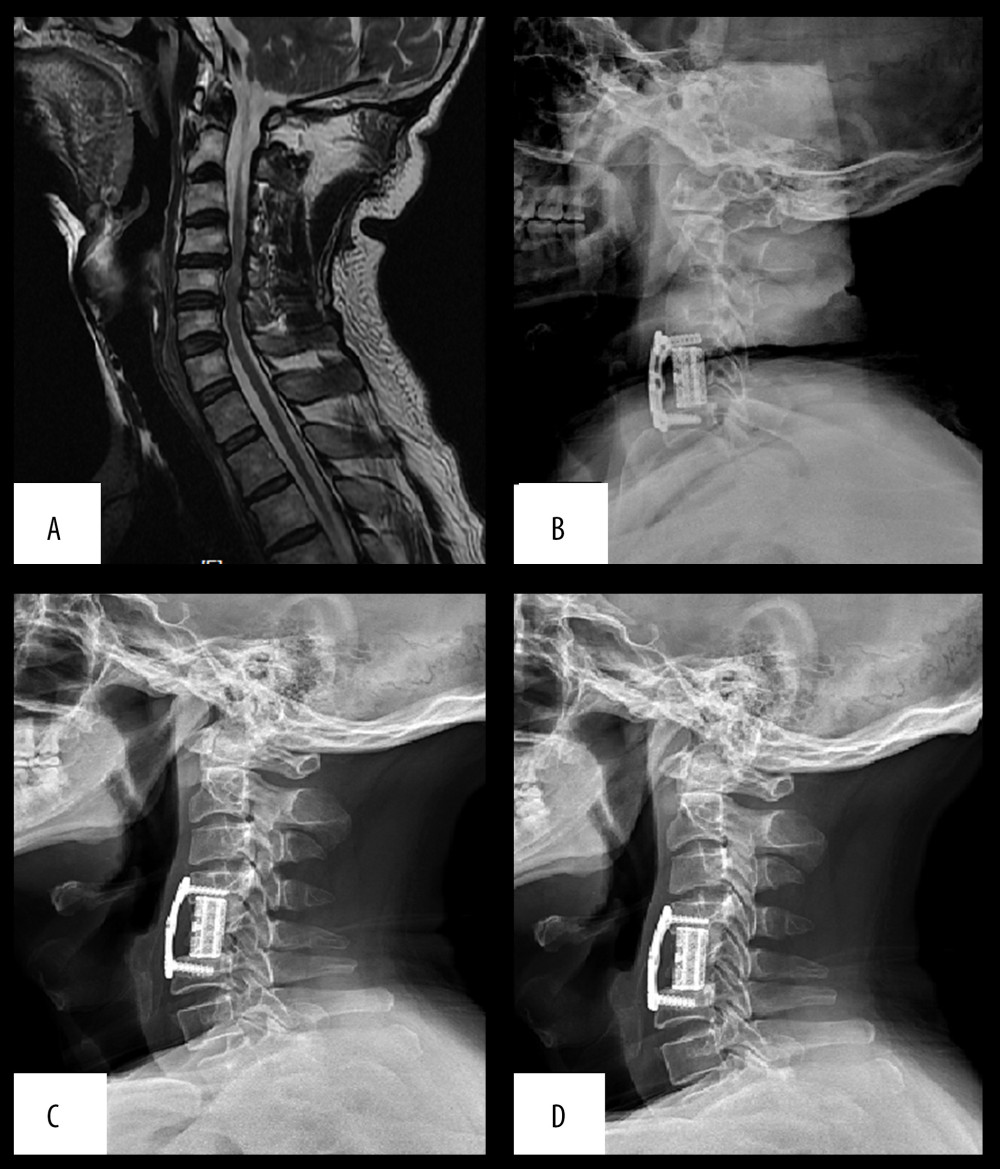 (A) Preoperative MRI showed compression and deformation of cervical spinal cord behind C4/C5 vertebral body (B) 1 week after surgery, (C) 3 months after surgery, and (D) 1 year after surgery.