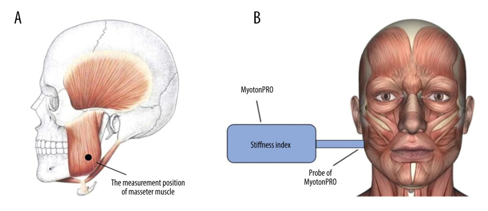 (A) The measurement position of the masseter muscle. (B) The direction of the probe of the MyotonPRO apparatus.