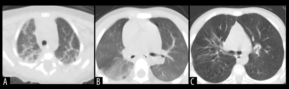 Radiographic characteristics of representative patients. (A) A patient with MP-associated bronchiolitis. Messy, reticular, high-density shadows, with lamellar shadows were found on chest CT. (B) A patient with MP-associated bronchiolitis. Markings accompanied by a misty fuzziness on chest CT. (C) A patient with RSV-associated bronchiolitis. Chest CT shows increased brightness in the bilateral lungs.