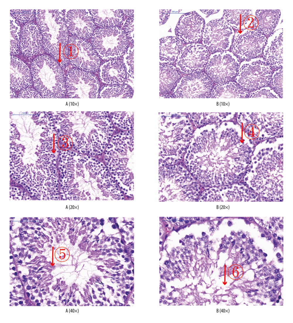 Analyses of testicular tissue in mice using hematoxylin-eosin (H&E) staining. The testicular tissue of mice was stained with H&E to observe pathologic changes in the testes under electron microscopy (n=6 animals per group). In group A: (i) The convoluted tubules are closely arranged, and the boundary between the basal membrane and the stroma is clear and even (arrow ?); (ii) all levels of spermatogenic cells and spermatogenic cells are arranged in order (arrows ?, ?). In group B: (i) Spermatogenic tubules are injured to different degrees, and the seminiferous tubules were sparsely arranged, showing interstitial edema, and their epithelium was separated from the matrix (arrow ?); (ii) the number of Sertoli cells in testes was significantly reduced and arranged loosely. The number of spermatozoa was significantly reduced (arrows ?, ?).
